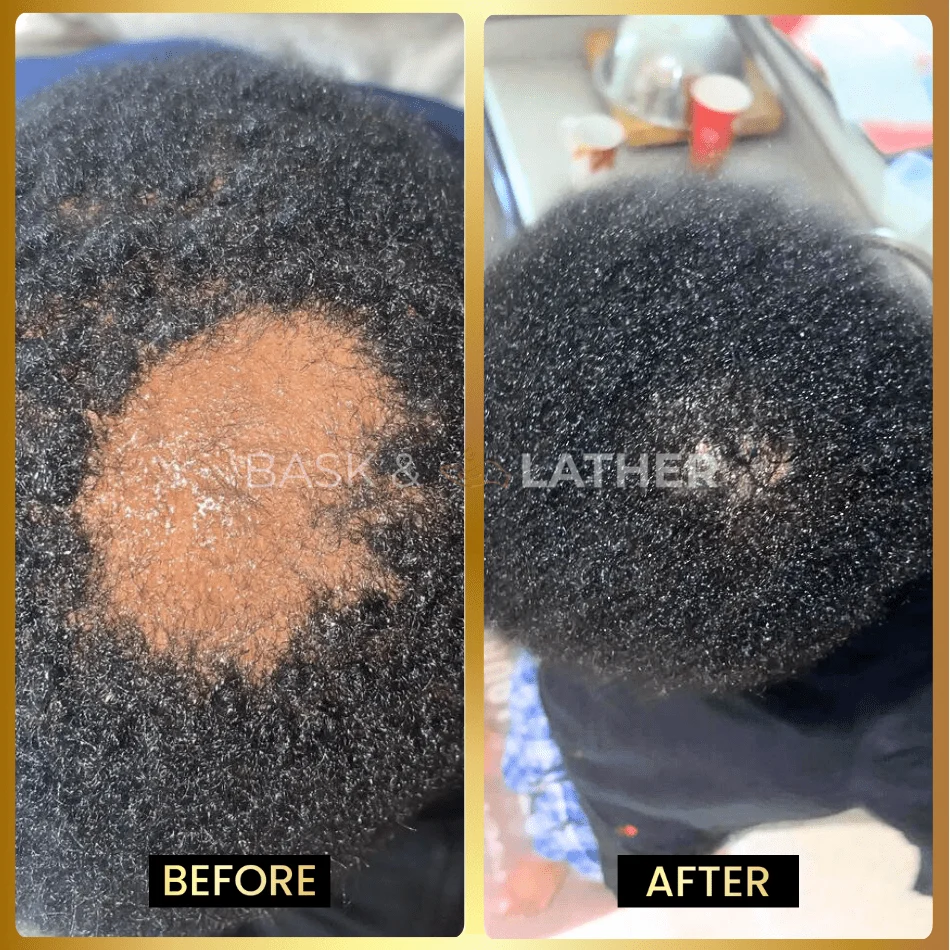 Scalp Stimulator - 3 Month Supply - Image 3