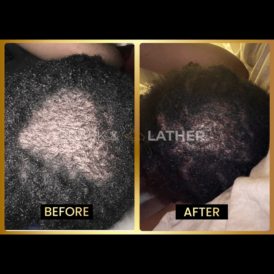 Scalp Stimulator - 3 Month Supply - Image 4